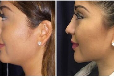 Chin Correction Surgery In Lucknow
