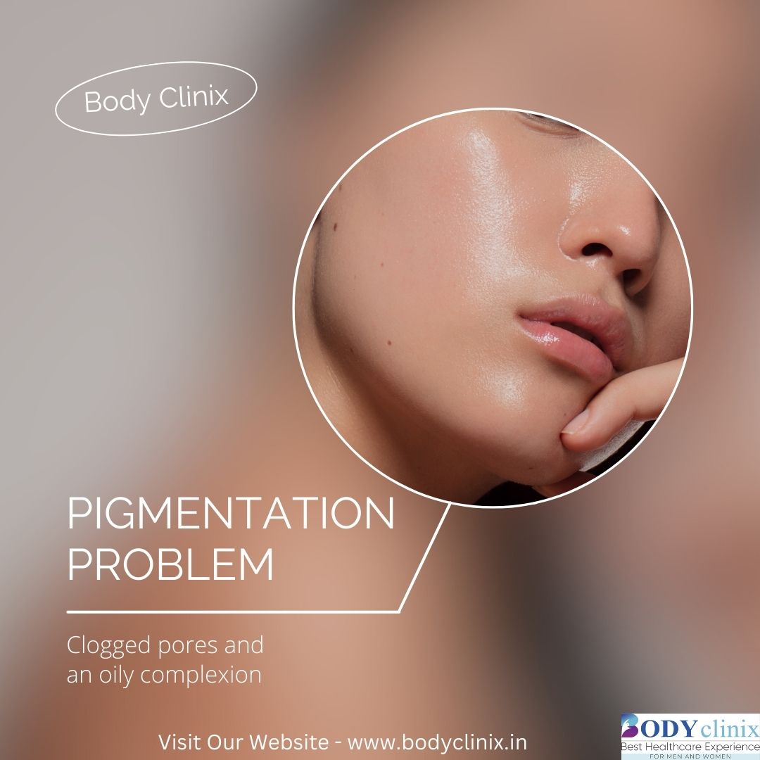 Pigmentation Removal in Delhi