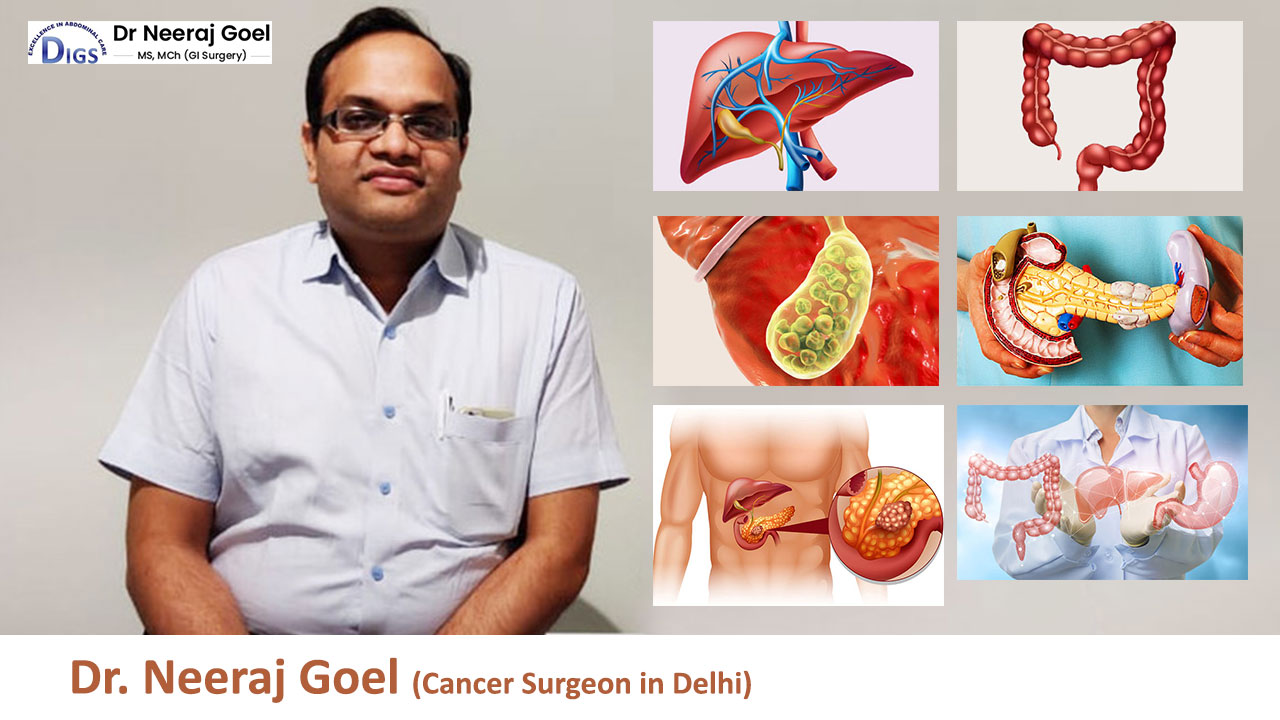 Dr. Neeraj Goel: The Best Cancer Surgeon in Delhi